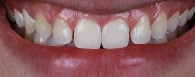Antes: fechamento de diastema
