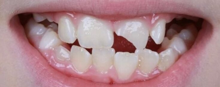 Antes: reconstrução de dente fraturado