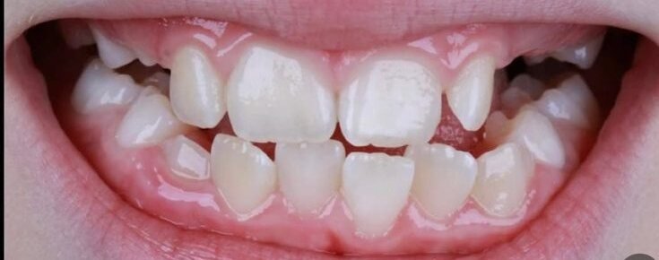 Depois: reconstrução de dente fraturado