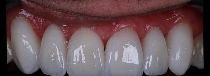 Depois: lentes de porcelana