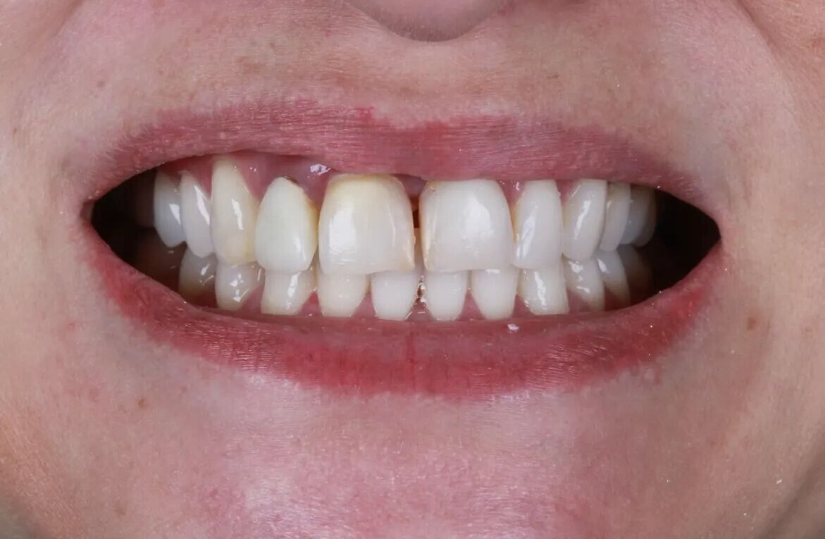 Antes: lentes de porcelana com troca de cor