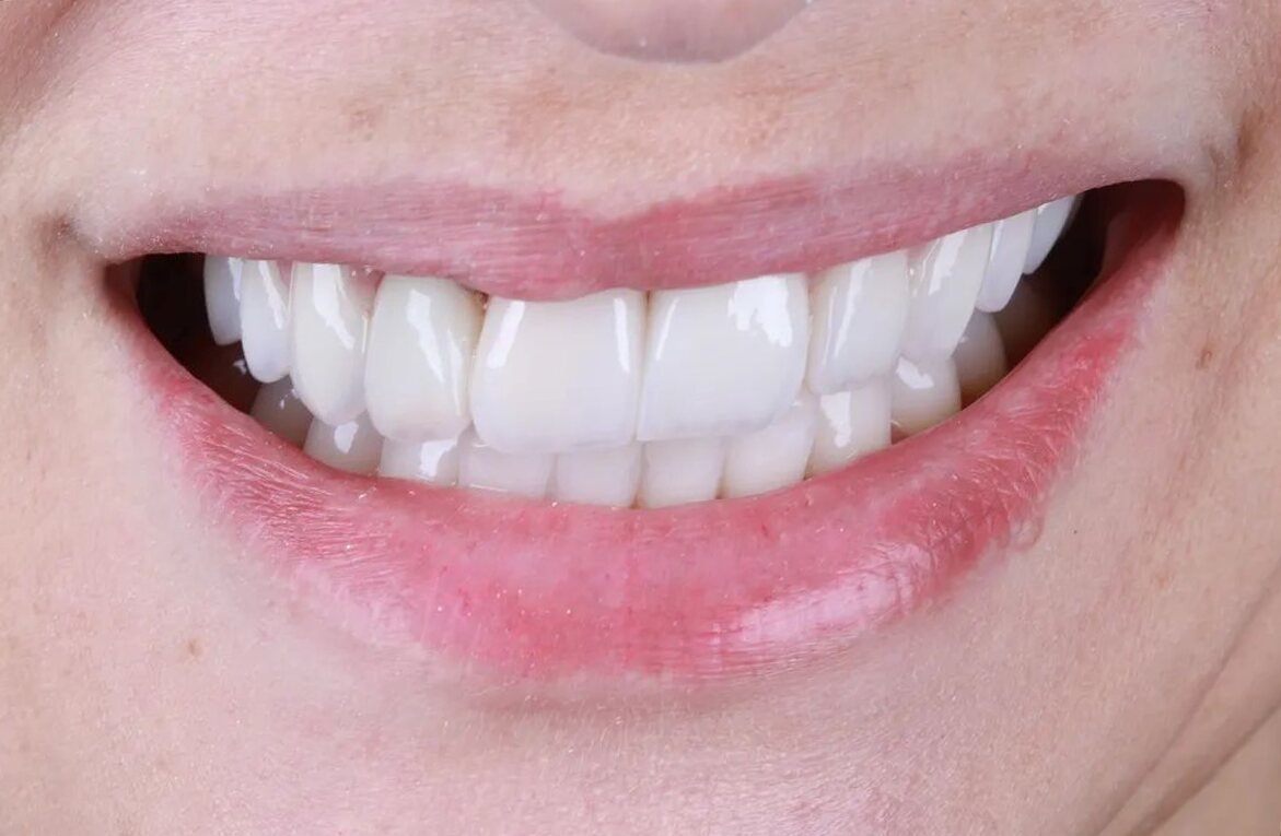 Depois: lentes de porcelana com troca de cor